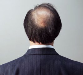 脱发给患者带来的生活影响?