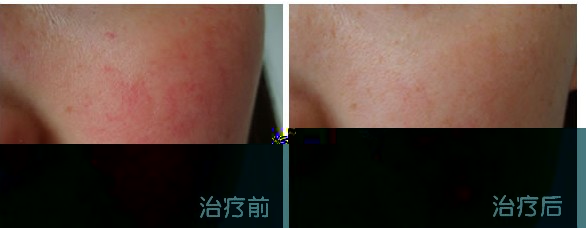 红血丝症状图片